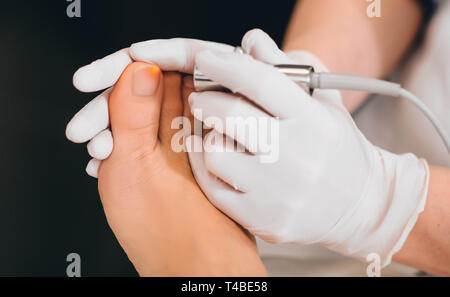 Il trattamento laser su toenail, infezione fungina sulla toenails Foto Stock