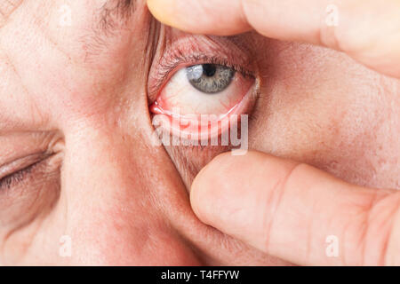 Un uomo di allargare il suo occhio con pollice e indice Foto Stock
