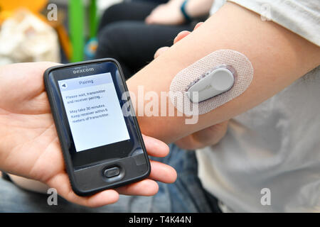 Un Dexcom G6 continua il monitoraggio di glucosio (CGM), è fissata al braccio di un paziente in una clinica medica, in base all'Università di Bristol. Stampa foto di associazione. Picture Data: lunedì 8 aprile 2019. Foto di credito dovrebbe leggere: Ben Birchall Foto Stock