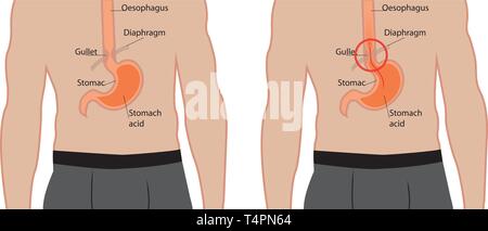 Il reflusso gastroesofageo malattia. Gerd nello stomaco di un corpo umano illustrazione vettoriale su sfondo bianco Illustrazione Vettoriale