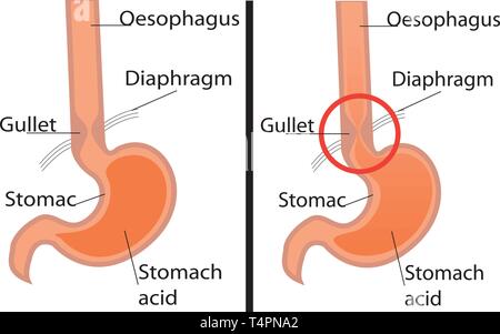 Il reflusso gastroesofageo malattia. Sana e Gerd stomaco illustrazione vettoriale su sfondo bianco Illustrazione Vettoriale