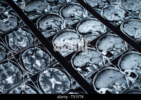 Cervello MRI scan della testa e del cranio Foto Stock