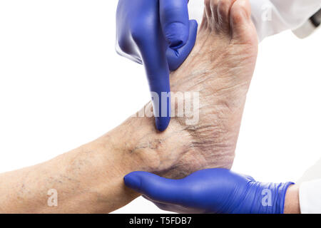 Medic viola che indossa i guanti chirurgici puntando con il dito indice in vena varicosa sulla gamba isolato su bianco Foto Stock