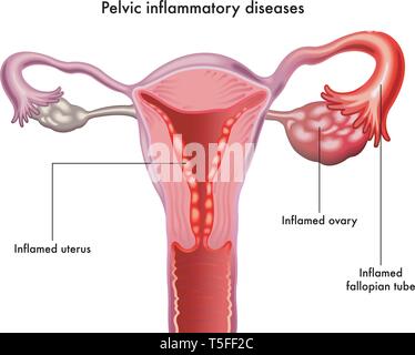 Pelvica malattie infiammatorie illustrato in forma anatomica su bianco. Illustrazione Vettoriale
