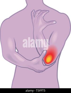 Una illustrazione medica dei sintomi del dolore a gomito o il gomito del tennista, noto anche come epicondiliti. Illustrazione Vettoriale