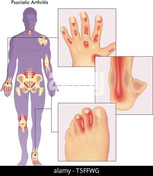 Illustrazione del corpo umano che mostra close up di anatomia effettuata da artrite psoriasica. Illustrazione Vettoriale