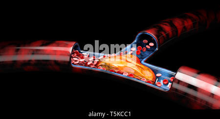 3d illustrazione di trombosi venosa profonda o coaguli di sangue, embolia nero isolato. Foto Stock
