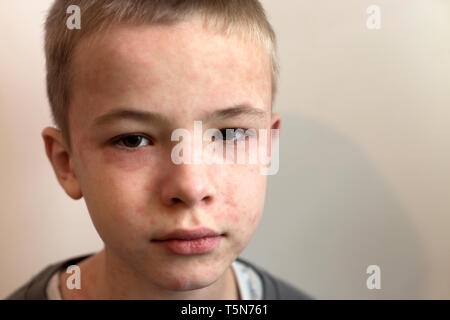 Ritratto di malati triste bambino affette da morbillo o varicella con dossi su tutta la faccia. Contagiosa malattie del bambino e il trattamento. Foto Stock