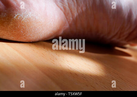 Primo piano immagine di un tacco sul piede con un callo bianco. Immagine per scopi medici. Foto Stock