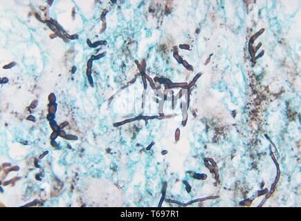 Metenamina silver stain fotomicrografia della variazioni istopatologiche associate con phaeohyphomycosis causato da Phytophthora parasitica, 1971. Immagine cortesia di centri per il controllo e la prevenzione delle malattie (CDC) / Dr Libero Ajello. () Foto Stock