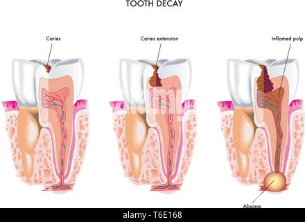 Illustrazione medica della carie dentaria processo Illustrazione Vettoriale