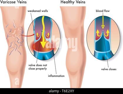 Illustrazione medica degli effetti delle vene varicose Illustrazione Vettoriale