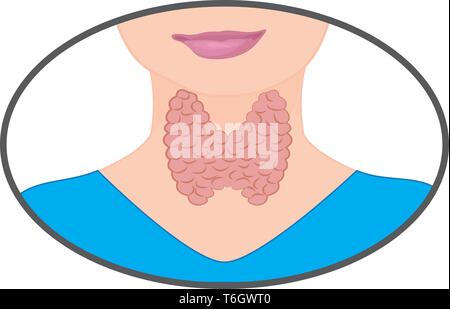 Gozzo. Tiroide ingrandita. La disfunzione endocrina illustrazione vettoriale su uno sfondo bianco. L'ipertiroidismo Illustrazione Vettoriale