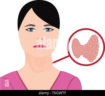 Gozzo. Malattie della tiroide. La disfunzione endocrina illustrazione vettoriale su uno sfondo bianco. L'ipertiroidismo Illustrazione Vettoriale