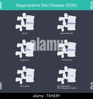 Questo è un sintomo di degenerazione ossea, la perdita del fluido in i tuoi dischi. rende il disco più sottile e la distanza tra le vertebre è stretta. Ana Illustrazione Vettoriale