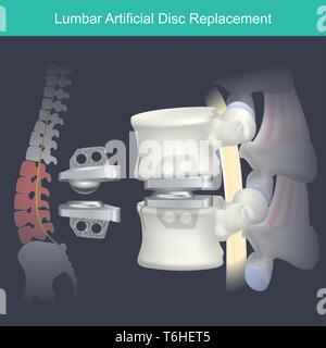 Materiale medico usato inserire tra le piccole ossa della colonna vertebrale (disco intervertebrale) è sostituito con un materiale sintetico. Illustrazione Vettoriale