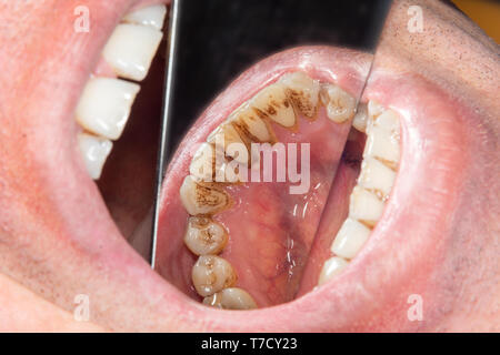 Denti umani con il fumo di placca e tartaro. Close-up macro dental clinic. Concetto di igiene Foto Stock