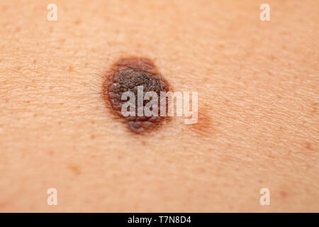 Close up foto di pericolose nevo marrone sulla pelle umana - il melanoma Foto Stock