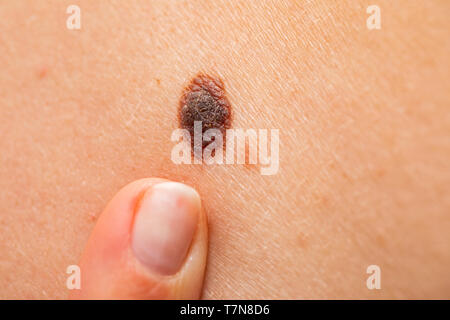Chiudere l immagine del dito puntato a pericolose nevo marrone sulla pelle umana - il melanoma Foto Stock