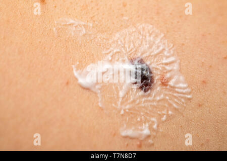 Close up foto di dark naevus sulla pelle con suncare lozione sulla parte superiore Foto Stock