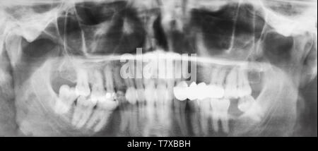 Vista frontale delle ganasce umana con la corona dentale su denti sulla immagine a raggi X Foto Stock