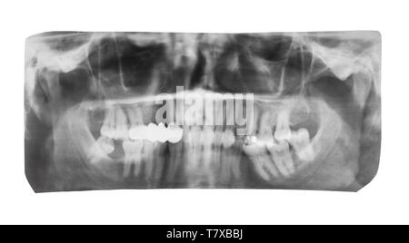 Film con immagine a raggi X di ganasce umana con la corona dentale su denti isolati su sfondo bianco Foto Stock