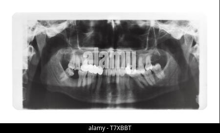 Film con immagine a raggi X di ganasce umana con la corona dentale e perni in denti isolati su sfondo bianco Foto Stock