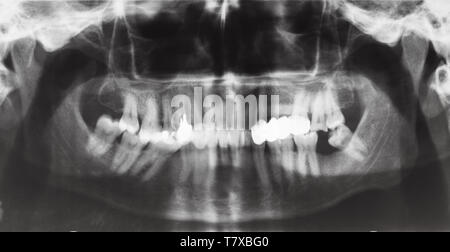 Vista frontale delle ganasce umana con la corona dentale e perni in denti sulla immagine a raggi X Foto Stock