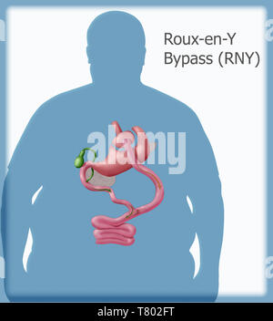 Roux-en-Y gastrico chirurgia di bypass Foto Stock