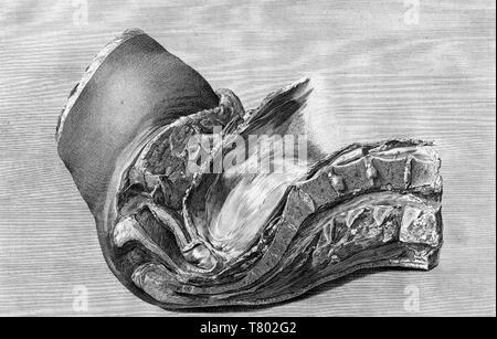 William Hunter, Anatomia uteri humani gravidi, 1774 Foto Stock