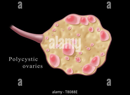 Sindrome policiatica ovarica, illustrazione Foto Stock