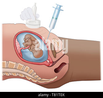 Amniocentesis, illustrazione Foto Stock