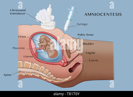 Amniocentesis, illustrazione Foto Stock