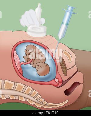 Amniocentesis, illustrazione Foto Stock