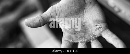 Palm con calli. Il duro lavoro del concetto. Le vesciche sulla mano infortunata dal lavoro manuale. Foto Stock