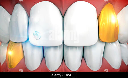 Denti di oro e dente gem, illustrazione Foto Stock