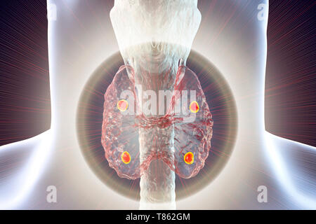 Ghiandole paratiroidi, illustrazione Foto Stock