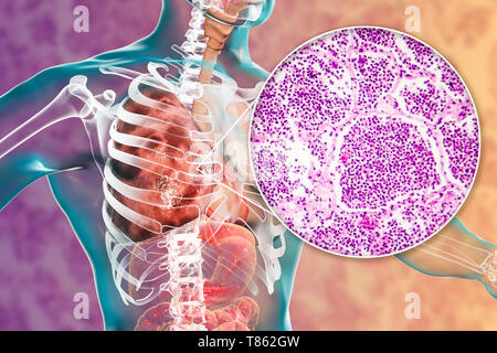Lobar polmonite, illustrazione e microfotografia luminosa Foto Stock