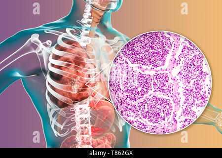 Lobar polmonite, illustrazione e microfotografia luminosa Foto Stock
