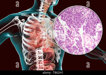 Lobar polmonite, illustrazione e microfotografia luminosa Foto Stock