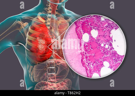 Lobar polmonite, illustrazione e microfotografia luminosa Foto Stock