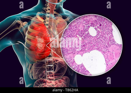 Lobar polmonite, illustrazione e microfotografia luminosa Foto Stock