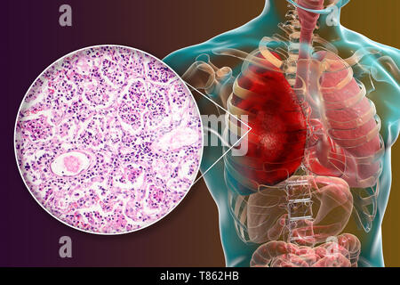 Lobar polmonite, illustrazione e microfotografia luminosa Foto Stock