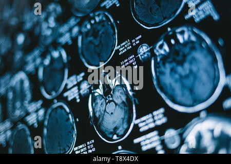 Immagini a risonanza magnetica della testa. Raggi X, MRI, cervello, medicina, la scienza Foto Stock