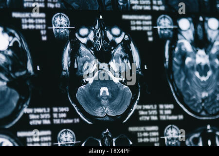 Immagini a risonanza magnetica della testa. Raggi X, MRI, cervello, medicina, la scienza Foto Stock