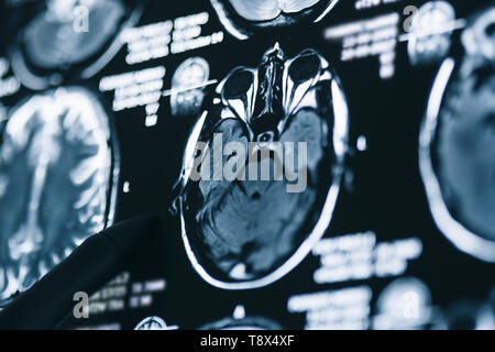 La risonanza magnetica la scansione del cervello. Testa di MRI scan. Medicina, la scienza Foto Stock