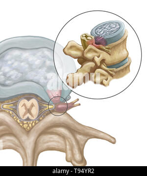 Una illustrazione della formazione di ernia di un disco intervertebrale a livello del tratto lombare della colonna vertebrale. Gli individui soffrono di una ernia del disco quando l'esterno del tessuto fibroso del disco, noto come l'anello fibroso, può rompersi a causa di un trauma o di vecchiaia. Come risultato, il gel come centro del disco sporge verso l'esterno e comprime i nervi nel retro, indebolimento muscolare e provocando forti dolori alla schiena. Foto Stock