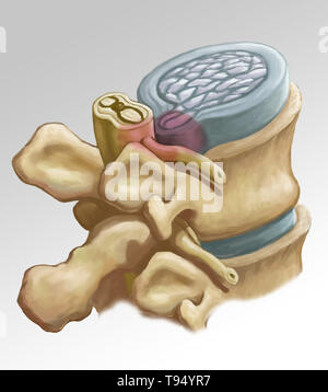 Una illustrazione della formazione di ernia di un disco intervertebrale a livello del tratto lombare della colonna vertebrale. Gli individui soffrono di una ernia del disco quando l'esterno del tessuto fibroso del disco, noto come l'anello fibroso, può rompersi a causa di un trauma o di vecchiaia. Come risultato, il gel come centro del disco sporge verso l'esterno e comprime i nervi nel retro, indebolimento muscolare e provocando forti dolori alla schiena. Foto Stock