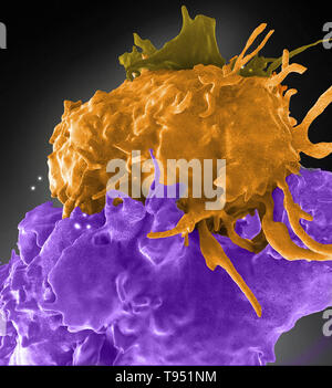 Struttura tridimensionale di HIV infetti (blu, verde) e cellule non infettate (marrone, viola) cellule T interagenti. Una cella (marrone) è avvolta una estensione intorno al suo prossimo non infetti (viola) per raggiungere una cellula infettata (blu). La sindrome da immunodeficienza acquisita (AIDS) è una malattia cronica, potenzialmente a rischio per la vita condizione causata dal virus di immunodeficienza umana (HIV). Da danneggiare il vostro sistema immunitario, HIV interferisce con la capacità del corpo di combattere gli organismi che causano la malattia. Foto Stock