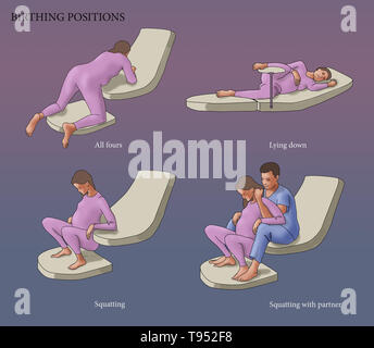 Illustrazione di quattro diverse posizioni del parto: carponi, sdraiato, accucciata, e accovacciata con un partner. Foto Stock